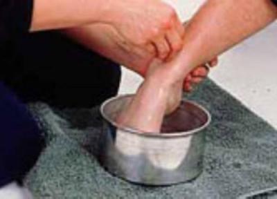 سرمازدگی و راه های پیشگیری